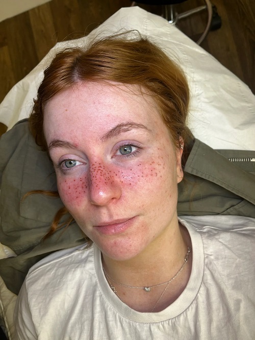 Freckle Tattoo Ideas 1
